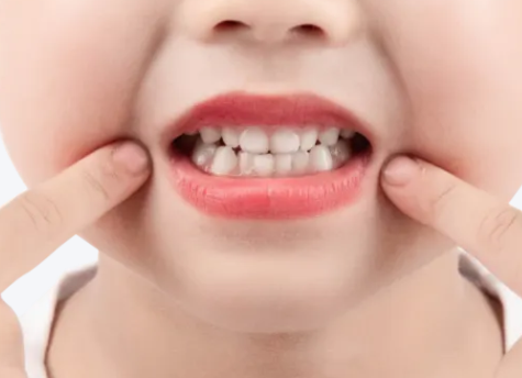 涂氟后多久能刷牙？河北惟德口腔醫(yī)生專業(yè)答疑
