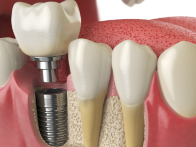 選擇種植牙后要做哪些日常維護(hù)？