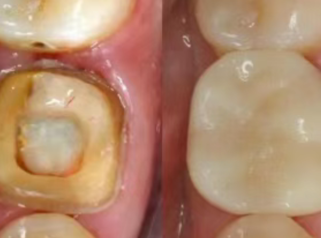 根管治療（抽神經(jīng)）后，為什么一定要做牙冠？