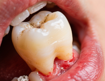 牙齒松動最佳補救方法