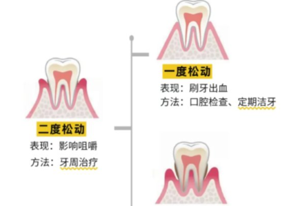 老年人牙齒松動(dòng)了要怎么辦？