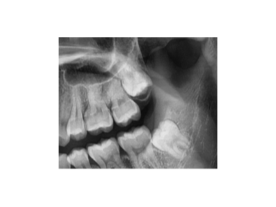 既然「智齒」不宜久留，為什么不能一次性拔掉？