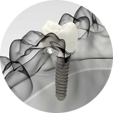 術(shù)前研究、模擬提升種植成功率