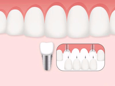 惟德口腔口腔種植怎么樣？惟德口腔就來為您一一解答