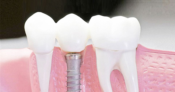 在承德口腔種植牙齒需要多少錢？惟德口腔一一為您道來